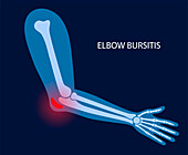 Elbow bursitis, illustration