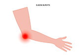 Elbow bursitis, illustration