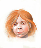 Teenage girl with foetal alcohol syndrome, illustration