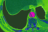 Aortic dissection, CT scan