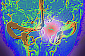 Cerebral venous thrombosis, angiography