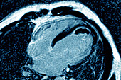Cardiac thrombus, MRI scan