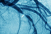 Stenosis due to myocardial infarction, angiography