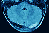 Cerebral venous thrombosis, MRI scan