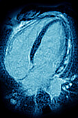 Myocarditis, MRI scan