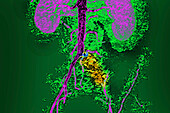 Thrombosis of iliac artery, MRA scan