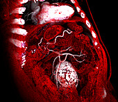 Aortic aneurysm, 3D CT scan