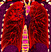 Bronchiectasis, 3D CT scan