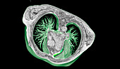 Healthy lungs and mediastinum, 3D CT scan