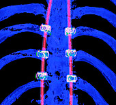 Pinned spine, 3D CT scan