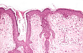 Chronic discoid lupus erythematosus, light micrograph