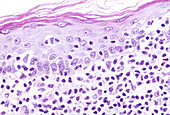 Cutaneous t cell lymphoma, light micrograph