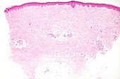 Scleroderma, light micrograph