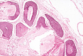 Pilomatrixoma, light micrograph