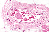 Meningococcal septicaemia, light micrograph