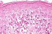 Erythema nodosum, light micrograph