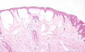 Lymphangioma circumscriptum, light micrograph