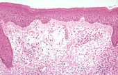 Erythema multiforme (dermal), light micrograph