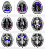 Amyloid PET scan of the brain, mildly positive
