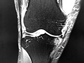 Knee joint with arthritis, MRI scan