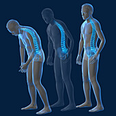 Osteoporosis, illustration