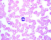 Human blood smear with neutrophil, light micrograph