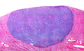 Lymphosarcoma in human kidney, light micrograph