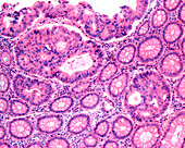 Adenocarcinoma in human colon, light micrograph
