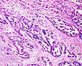 Ovarian mucinous cystadenocarcinoma, light micrograph