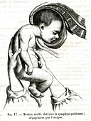 Breech pregnancy, 19th century illustration