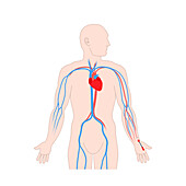Arterial line catheter, illustration