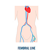 Femoral central venous catheter, illustration