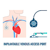 Venous access port, illustration