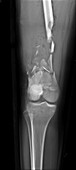 Broken leg, x-ray