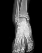 Broken ankle, X-ray