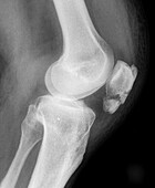 Broken knee cap, X-ray
