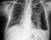 Hydropneumothorax, X-ray