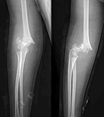 Supracondylar fracture, X-ray