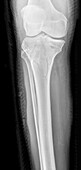 Tibial plateau fracture, X-ray