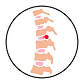 Intervertebral hernia, illustration