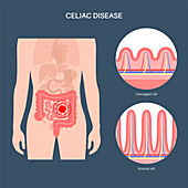 Celiac disease inflammation, illustration