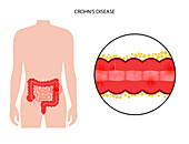 Chron's disease, conceptual illustration