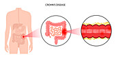 Chron's disease, conceptual illustration