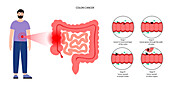 Colon cancer stages, illustration