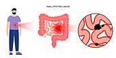 Small intestine cancer, illustration