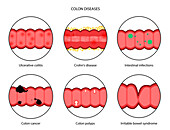 Intestinal diseases, illustration