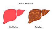 Liver disease, illustration