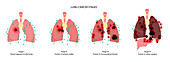 Lungs cancer, illustration