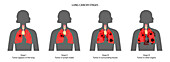 Lungs cancer stages, illustration