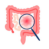 Intestinal diseases, illustration